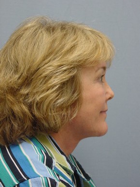 non surgical face lift