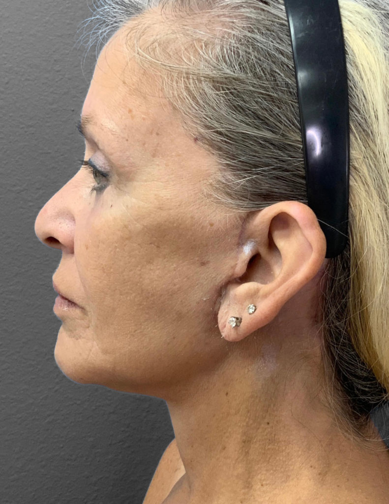 Profile view of a mature woman showcasing natural beauty and skin rejuvenation.