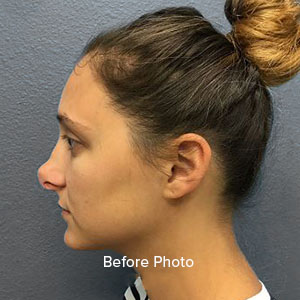 Profile view of a woman before rhinoplasty at Lentz Plastic Surgery.