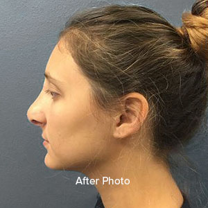 Profile view of a woman's refined nose after rhinoplasty at Lentz Plastic Surgery.
