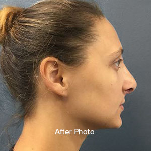 Revision rhinoplasty