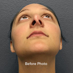 Before photo highlighting a patient's profile for Lentz Plastic Surgery.