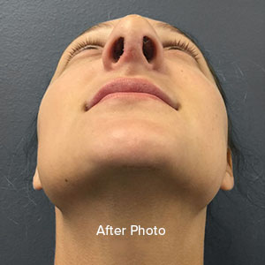 Post-surgery profile view highlighting refined nasal structure.