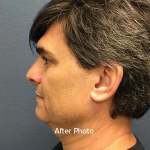 Male patient profile after cosmetic surgery, showcasing refined facial contours.