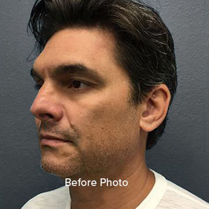 Male patient profile view, before facial surgery at Lentz Plastic Surgery.