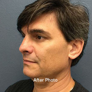 Male patient profile after cosmetic procedure, showcasing enhanced facial contours.