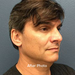 Male patient profile after cosmetic procedure, showcasing natural results.
