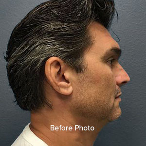 Male patient profile before plastic surgery consultation at Lentz Plastic Surgery.