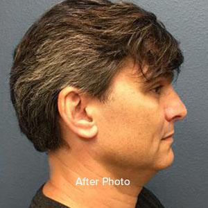 Profile view of male patient post-surgery, showcasing refined facial contours.