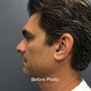 Before photo showcasing male profile, highlighting facial contours for Lentz Plastic Surgery.