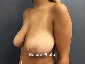 Before photo of breast augmentation patient at Lentz Plastic Surgery.
