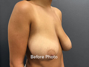Before photo showcasing breast augmentation results at Lentz Plastic Surgery.