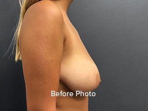 Before photo of breast augmentation patient at Lentz Plastic Surgery.