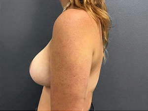 Side profile of a woman post-breast augmentation at Lentz Plastic Surgery.