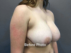 Before photo of breast augmentation patient, showcasing natural contours.