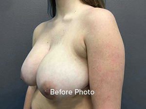 Breast augmentation before photo showcasing patient profile and skin tone.