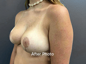 Breast augmentation after photo showcasing natural results at Lentz Plastic Surgery.