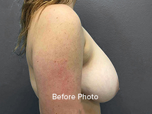 Before photo showcasing breast enhancement results at Lentz Plastic Surgery.