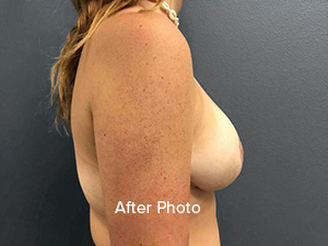 Breast augmentation after photo showcasing natural results at Lentz Plastic Surgery.