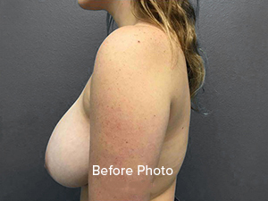 Before photo of breast augmentation patient, showcasing side profile.