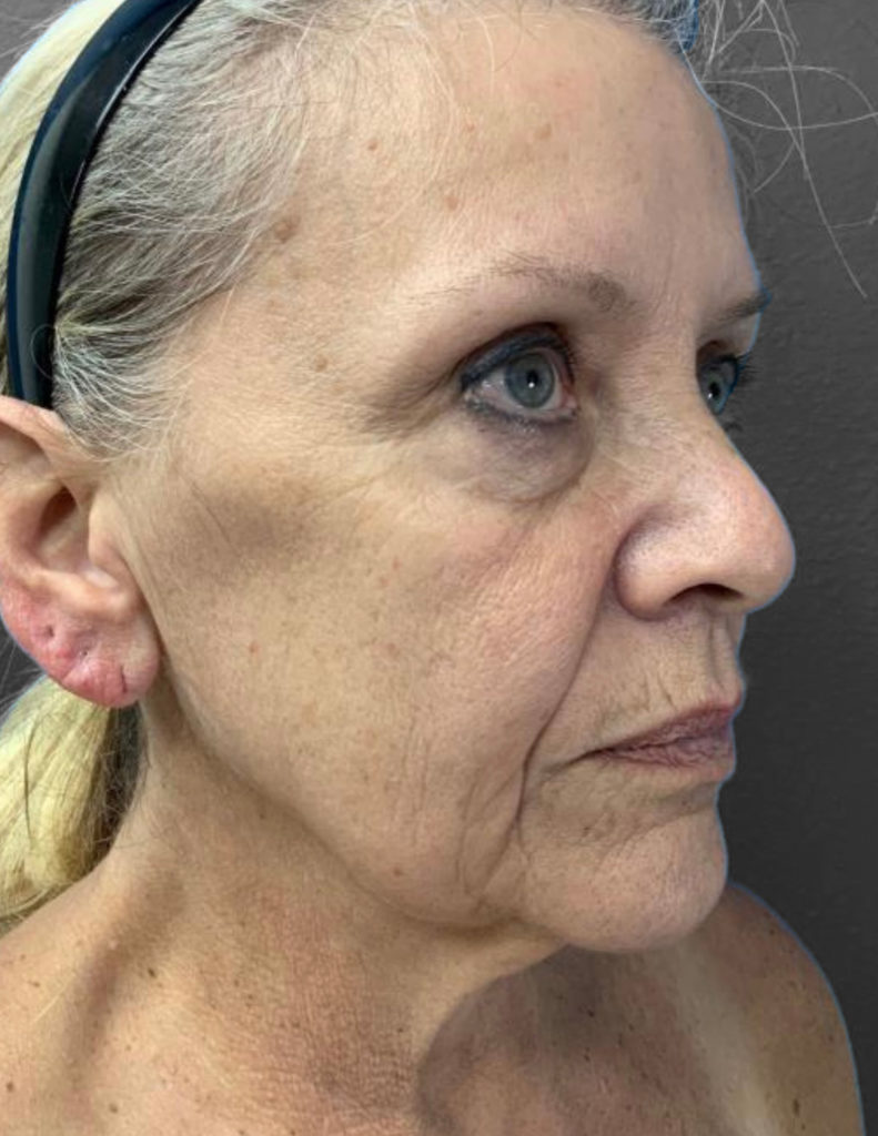 Profile view of mature woman highlighting skin texture and facial contours.
