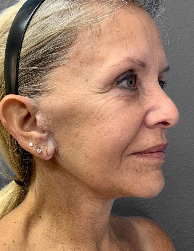 Profile view of a mature woman showcasing natural beauty and skin rejuvenation.