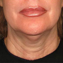 Before and after Botox treatment for forehead wrinkles