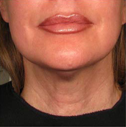 Visible improvement in forehead lines with Botox