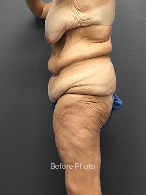 Before photo showcasing body contouring results at Lentz Plastic Surgery.