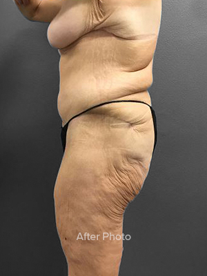 Post-surgery profile view highlighting body contouring results.