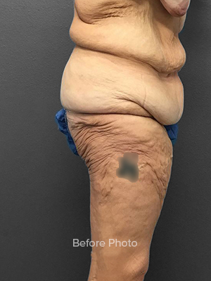 Before photo highlighting skin texture and contour issues for Lentz Plastic Surgery.