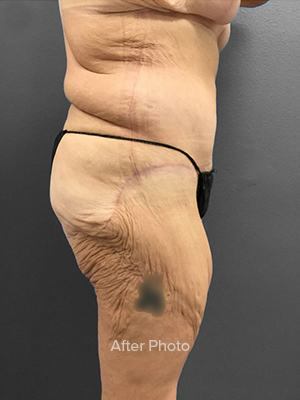 Post-surgery transformation showcasing improved body contouring results.