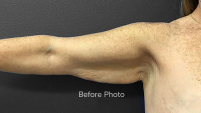 Arm Lift Brachioplasty Results Ormond Beach