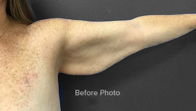Before photo highlighting arm contour for Lentz Plastic Surgery.