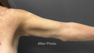 After photo showcasing arm contouring results by Lentz Plastic Surgery.