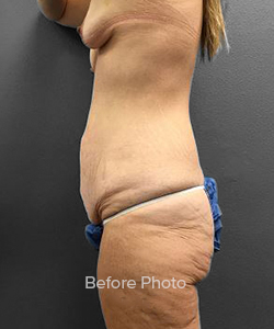 Before photo showcasing abdominal skin laxity at Lentz Plastic Surgery.