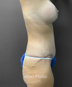 Post-surgery side profile showcasing improved body contouring results.