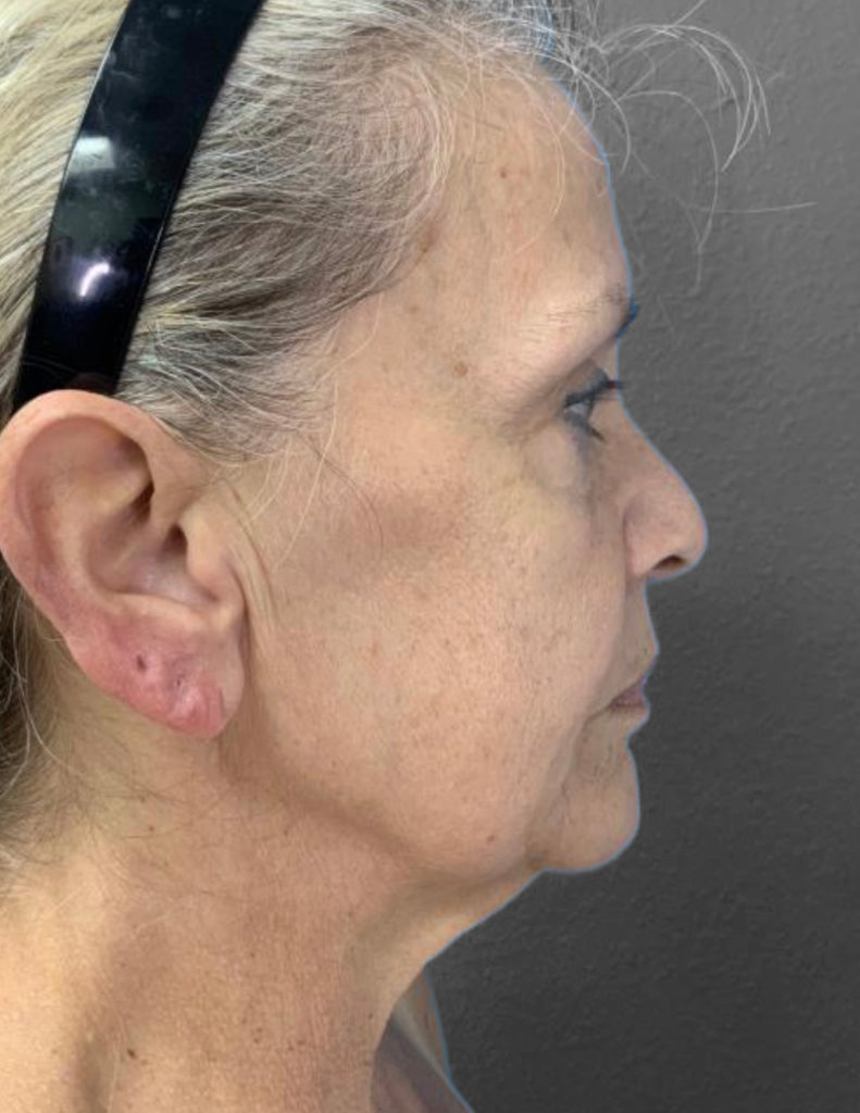 Profile view of mature woman highlighting facial rejuvenation results.