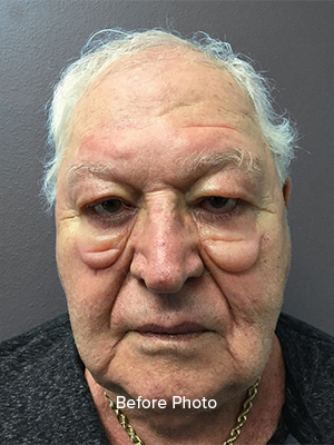 blepharoplasty