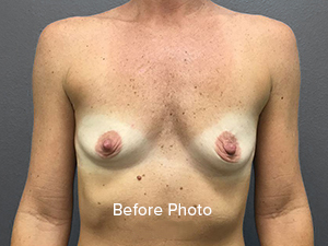 Size of implants - Breast Augmentation