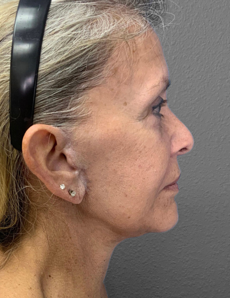 Profile view of a woman highlighting refined facial contours post-surgery.