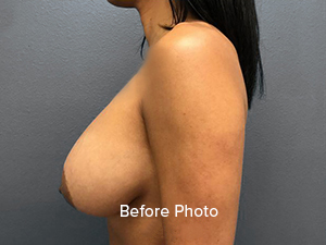 Before photo showcasing breast enhancement results at Lentz Plastic Surgery.