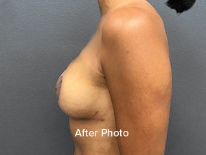 Breast augmentation after photo highlighting natural contours and professional results.