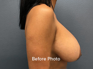 Before photo showcasing breast augmentation results at Lentz Plastic Surgery.