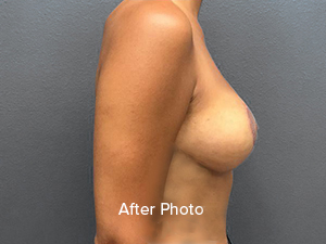 After photo showcasing enhanced breast contour and natural appearance.