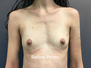 Breast Implant