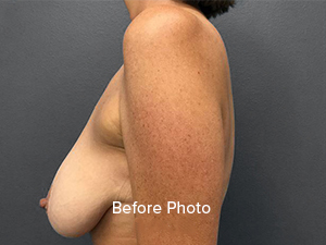 Before photo showcasing breast augmentation results at Lentz Plastic Surgery.