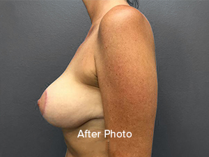 Breast augmentation after photo showcasing natural results and professional care.