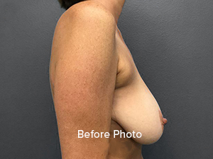 Before photo showcasing breast augmentation results at Lentz Plastic Surgery.