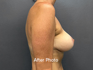 Breast augmentation after photo showcasing natural results and professional care.